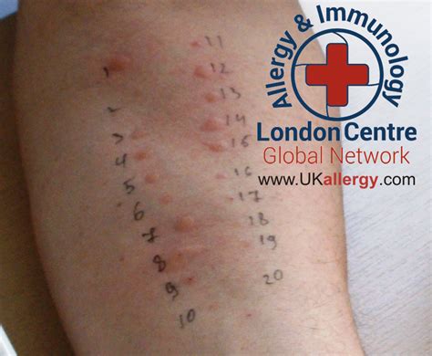 blood drop finger prick allergy testing|allergy patch test.